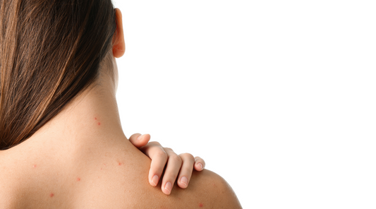 HOW TO PREVENT BACK ACNE