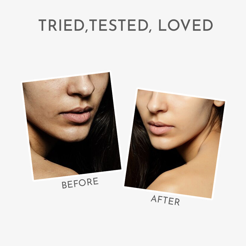 Before and after skincare results of Himaira&