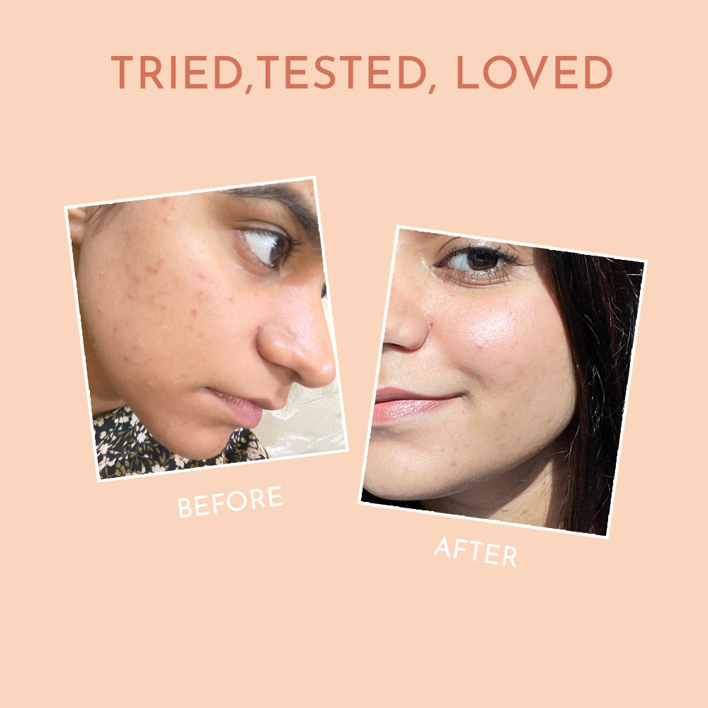 Before-after image of women showcasing the results of Himaira&