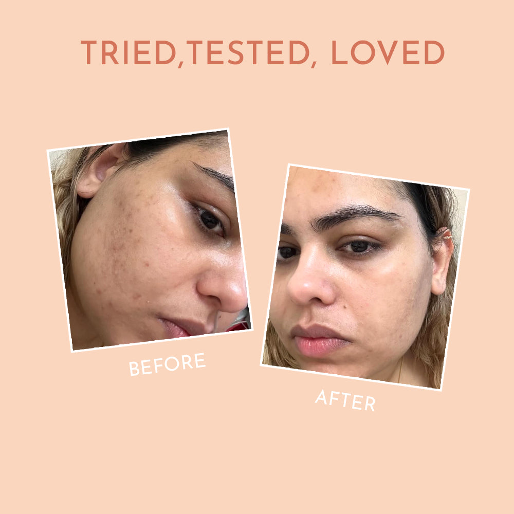 Comparison visual under Tried, Tested, Loved; Before features blemishes on the cheek, After using Himaira Hydro Bomb Mosturizer skin looks brighter and even.