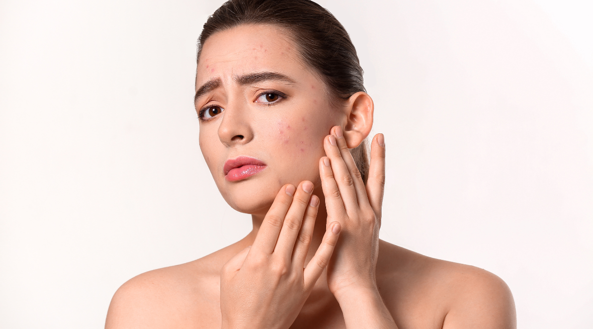 HOW TO PREVENT SEASONAL BREAKOUTS: TIPS FOR ACNE PRONE SKIN