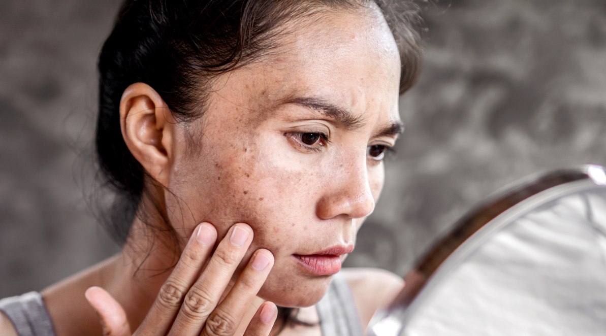 PIGMENTATION: CAUSES AND SOLUTIONS