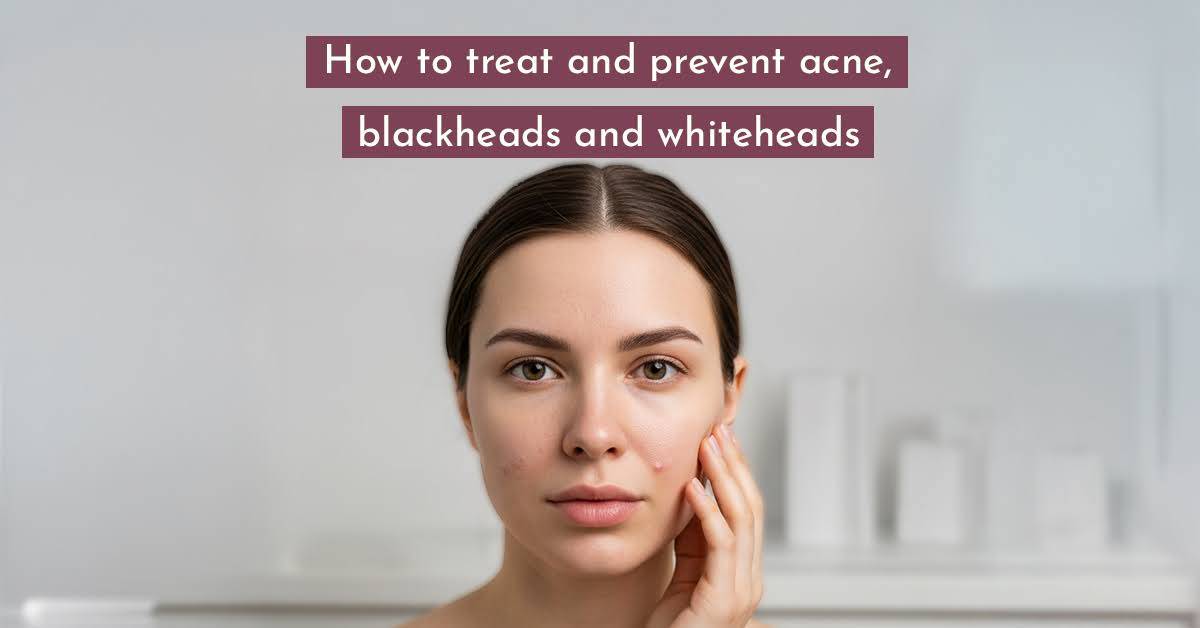 How To Treat And Prevent Acne, Blackheads And Whiteheads