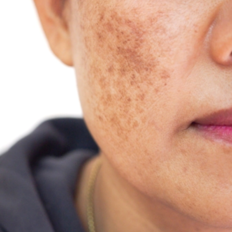 Dark Spots & Pigmentation